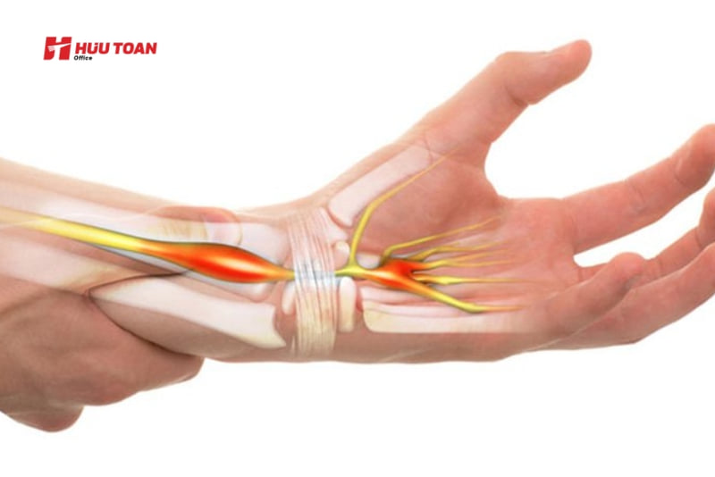 15 Bệnh của dân văn phòng thường gặp và cách phòng tránh Hội chứng ống cổ tay